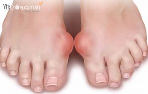 Cách ngâm chân giảm cơn đau gout