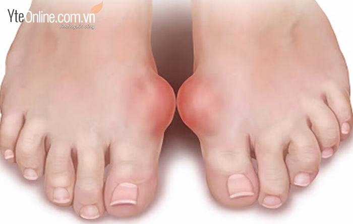 Cách ngâm chân giảm cơn đau gout